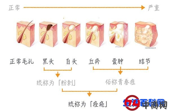 鼻子上的黑头是怎么形成的？教你该如何根除